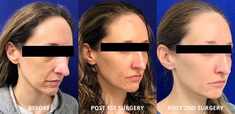 Fat Transfer Before and After Pictures Long Island & Manhattan, NY