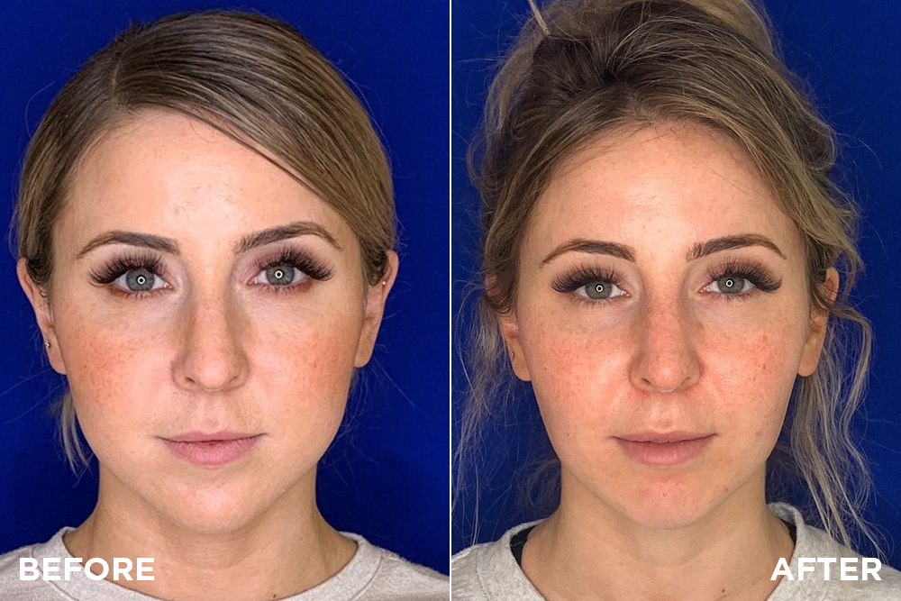 Two Procedures For Slimming Down A Round Face Madnani Facial Plastics