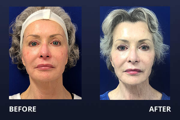 Photofacial Before and After Pictures Long Island & Manhattan, NY