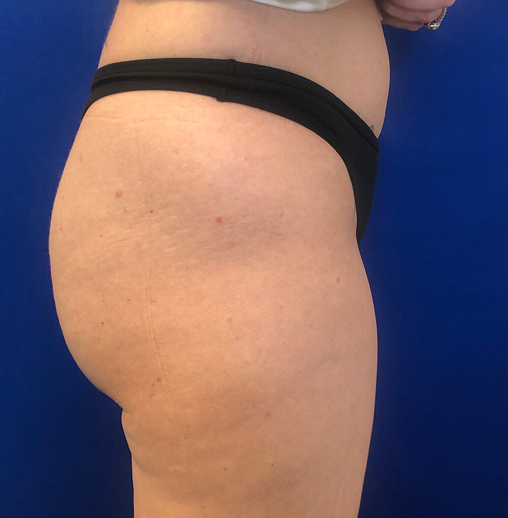 6 weeks POST NON SURGICAL BUTT LIFT 3