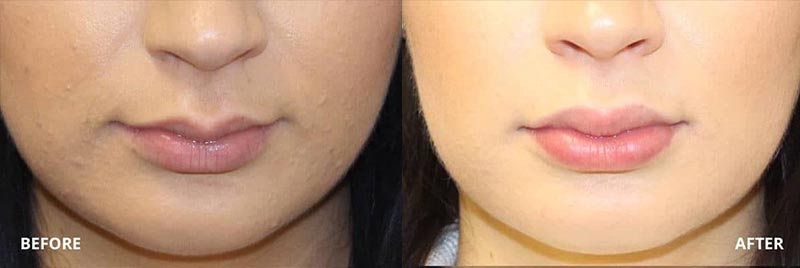 Before and After Injectables