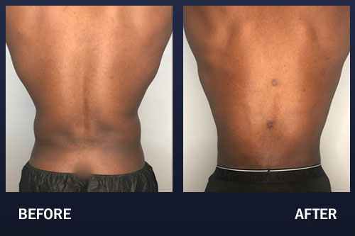 This male patient was unhappy with the stubborn fat in his lower abdomen. He underwent lower abdominal liposuction.