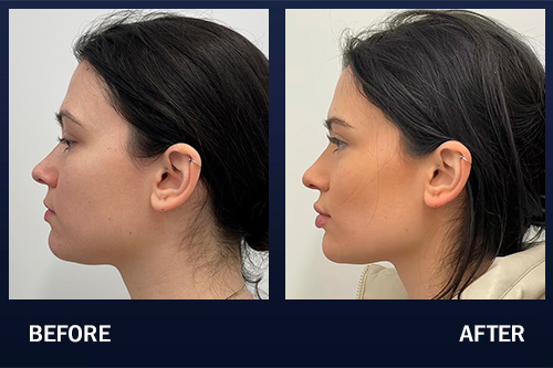 Jawline Contouring Before & After Pictures
