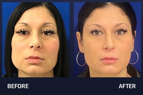 Botox Before and After Pictures: Real Results from Real Patients