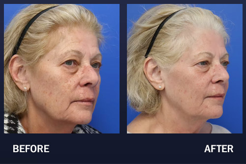CO2 Resurfacing Laser: Before, During, After