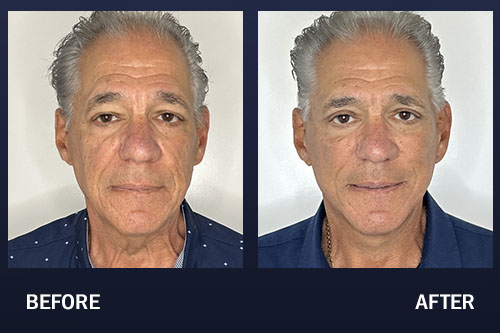 73 year old 2 months post Facelift, Neck lift, Facial Fat Transfer and Upper Blepharoplasty