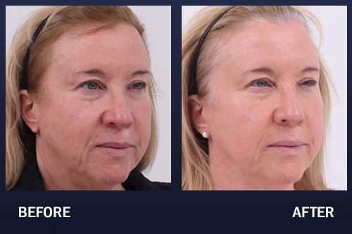 Before and after 2 sessions of BBL to treat Rosacea and uneven skin tone.