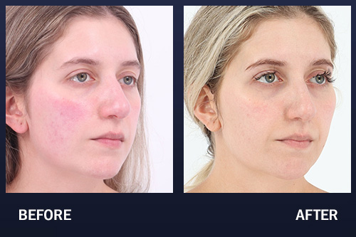 Before and after 3 sessions of BBL to treat rosacea.