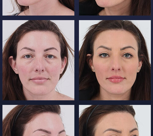 Facelift – 004