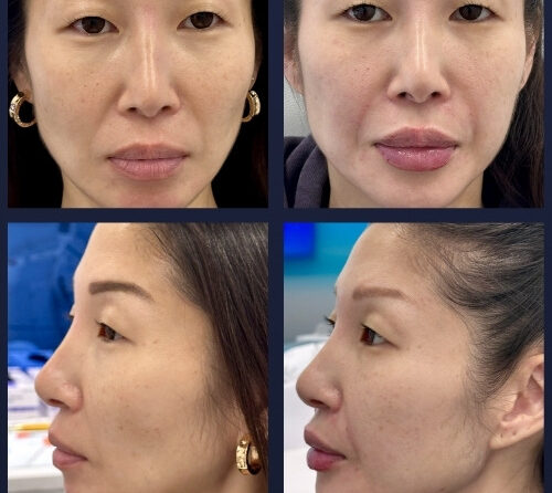 Submental Liposuction – 003