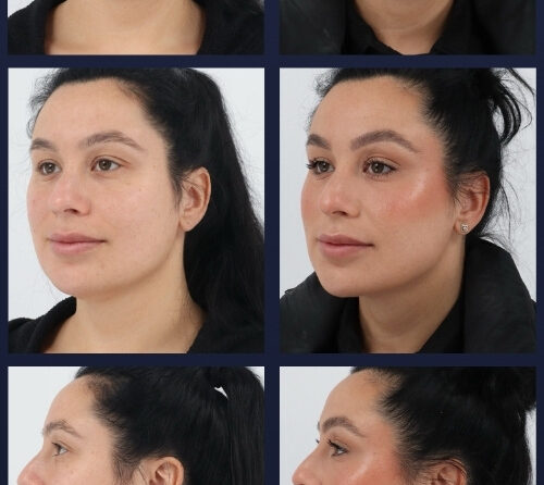 Submental Liposuction – 001