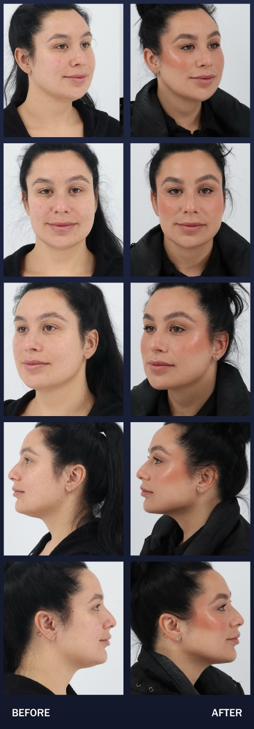 3 months after submental and lower face liposution