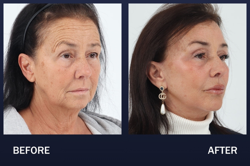 61 year old patient 4 months after a NaturaLyft™ with Dr. Madnani. She underwent a facelift, neck lift, brow lift, upper blepharoplasty, facial fat transfer and laser skin resurfacing