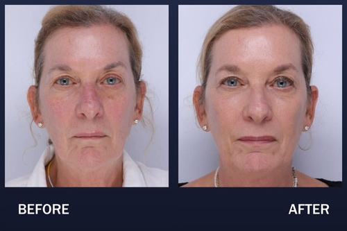Before and one week after PRF EZ Gel full face treatment.