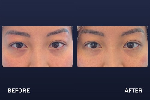 Before and 2 days after PRF EZ Gel to under eyes.