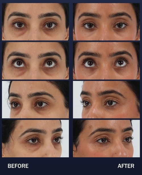32 year old 2 months after lower blepharoplasty with fat and nanofat transfer to the under eyes and cheeks with Dr. Chouake.