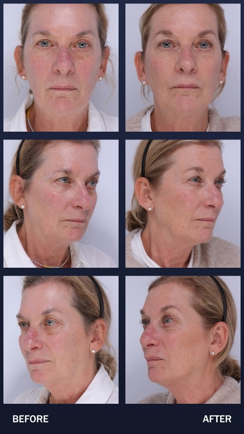 Madnani_B-A_3- 62 years old 6 weeks after 1st session. She has 2 more treatments to go to see optimal results.