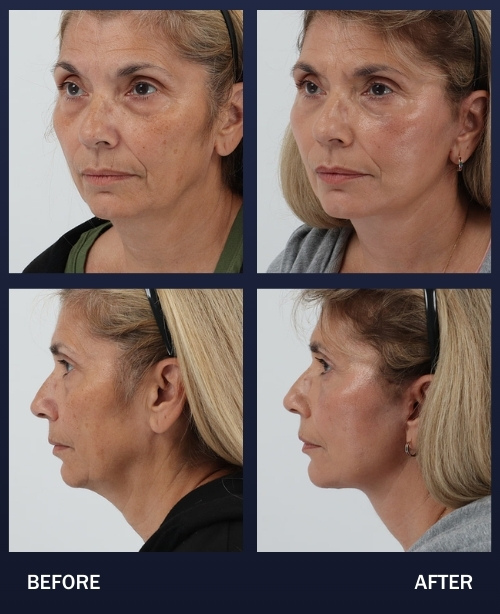61 year old Before and 2 months post Face and Neck lift with Dr. Chouake.