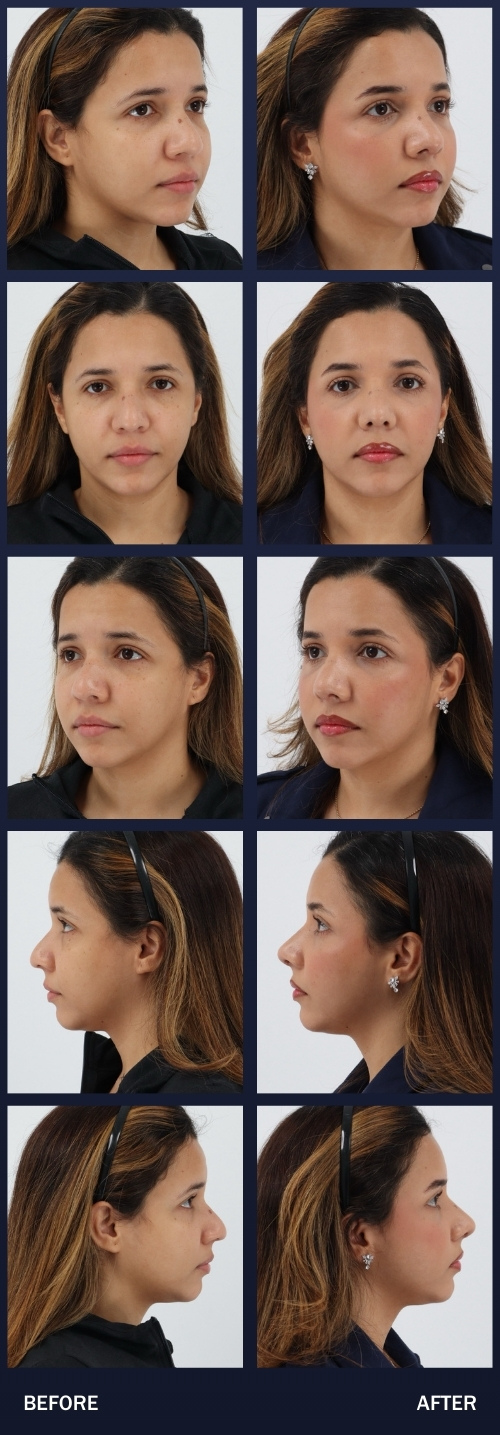 1 month after a Rhinoplasty with Dr. Chouake.