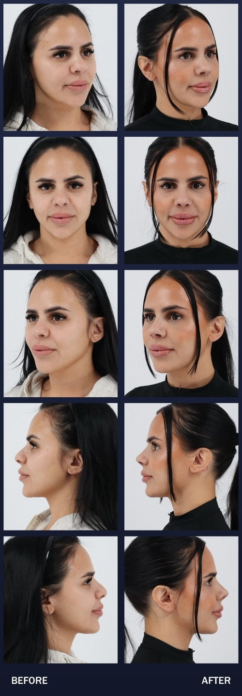 2 weeks after a Rhinoplasty by Dr. Chouake.