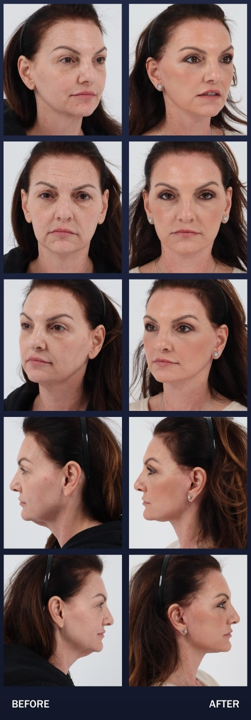 50 year old 1 month after Facelift, Neck lift, co2 laser with PDRN for skin rejuvenation.